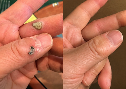 🔥DarkFairy 2-in-1 Microneedle & Hydrocolloid Patch🍀| Removes Raised Moles, Acne, Flat Warts & Skin Tags | Helps Improve Wrinkles, Scars & Blemishes | Invisible Patches for Face & Body